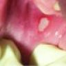 canker