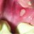 canker