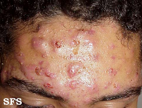 Acne4.JPG